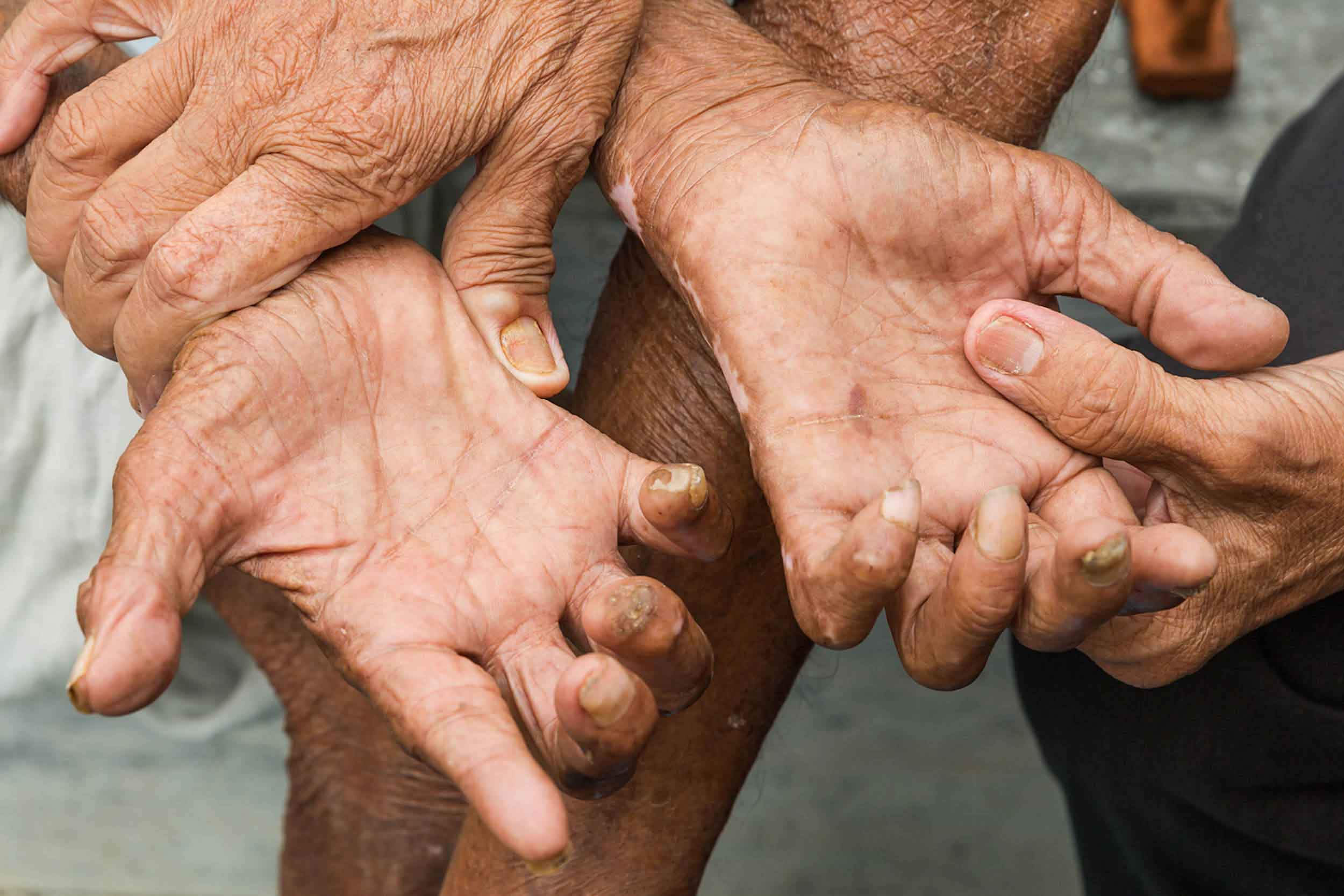 ASHA. Historias de lepra y esperanza